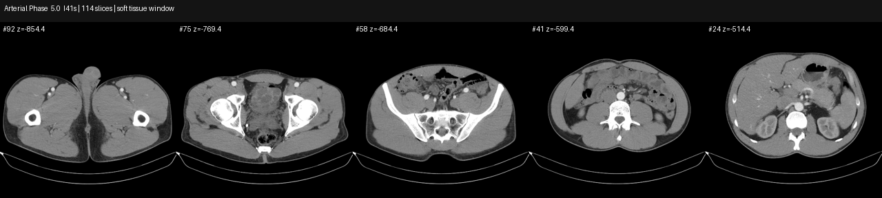 Arterial phase CT axial overview slices