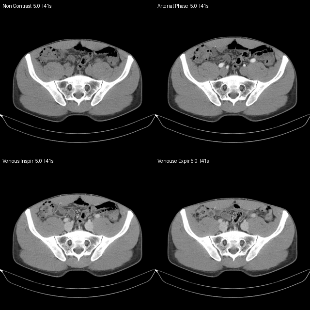 CT phase comparison: non-contrast, arterial, venous inspiratory, venous expiratory